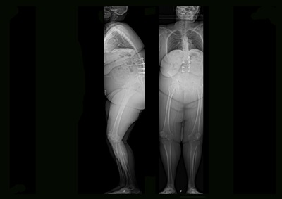 A pair of X-rays (side and front) show a woman with severe forward curvature of the spine.